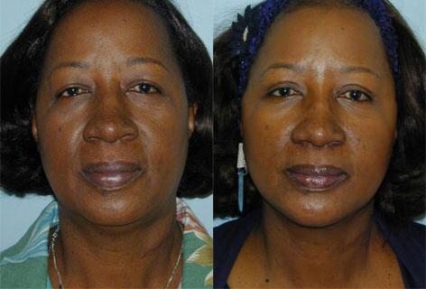 Facelift before and after photos in San Francisco, CA, Patient 14654