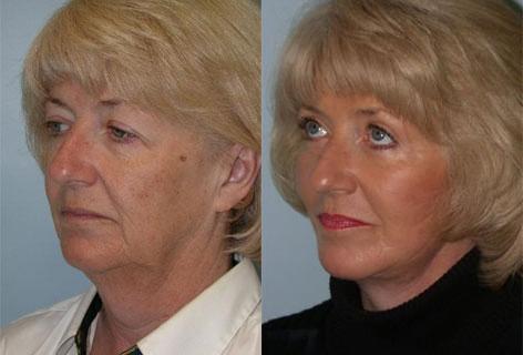 Facelift before and after photos in San Francisco, CA, Patient 14659