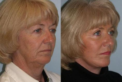 Facelift before and after photos in San Francisco, CA, Patient 14659