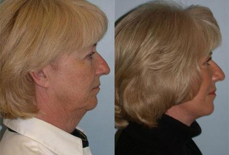 Facelift before and after photos in San Francisco, CA, Patient 14659