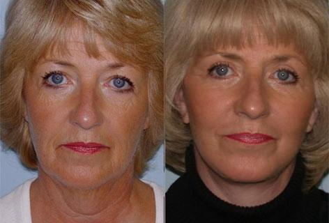 Facelift before and after photos in San Francisco, CA, Patient 14659