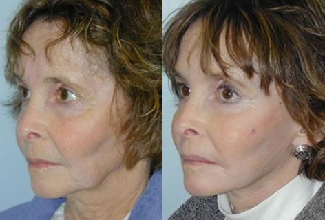 Facelift before and after photos in San Francisco, CA, Patient 14671