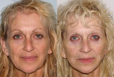 Facelift before and after photos in San Francisco, CA, Patient 14678