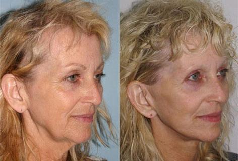 Facelift before and after photos in San Francisco, CA, Patient 14678