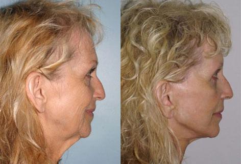 Facelift before and after photos in San Francisco, CA, Patient 14678