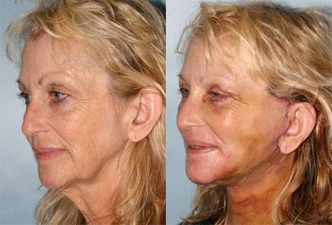 Facelift before and after photos in San Francisco, CA, Patient 14678