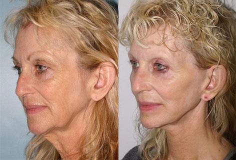 Facelift before and after photos in San Francisco, CA, Patient 14678