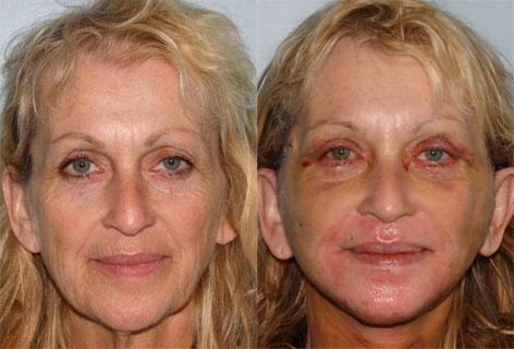 Facelift before and after photos in San Francisco, CA, Patient 14678