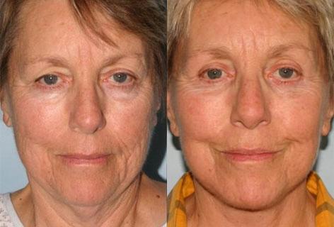 Facelift before and after photos in San Francisco, CA, Patient 14689