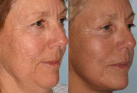 Facelift before and after photos in San Francisco, CA, Patient 14689