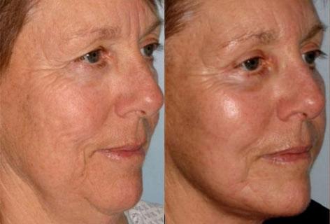 Facelift before and after photos in San Francisco, CA, Patient 14689