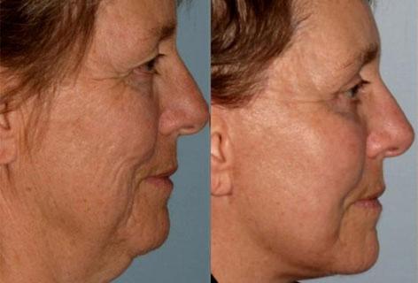 Facelift before and after photos in San Francisco, CA, Patient 14689