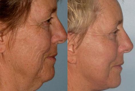 Facelift before and after photos in San Francisco, CA, Patient 14689