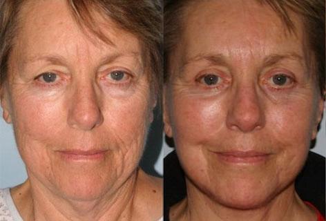 Facelift before and after photos in San Francisco, CA, Patient 14689