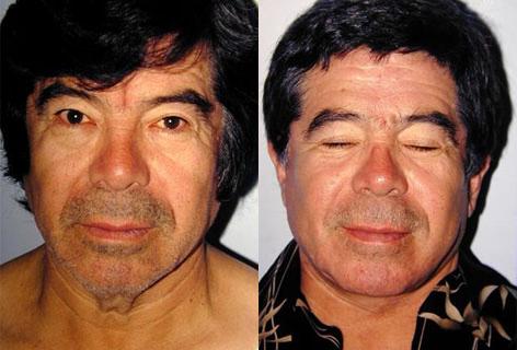 Facelift before and after photos in San Francisco, CA, Patient 14700