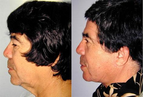 Facelift before and after photos in San Francisco, CA, Patient 14700