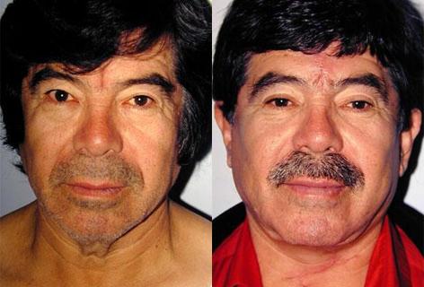 Facelift before and after photos in San Francisco, CA, Patient 14700