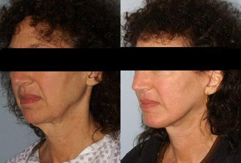 Facelift before and after photos in San Francisco, CA, Patient 14723