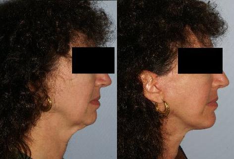 Facelift before and after photos in San Francisco, CA, Patient 14723