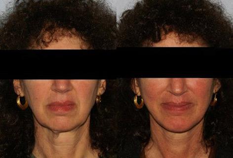 Facelift before and after photos in San Francisco, CA, Patient 14723