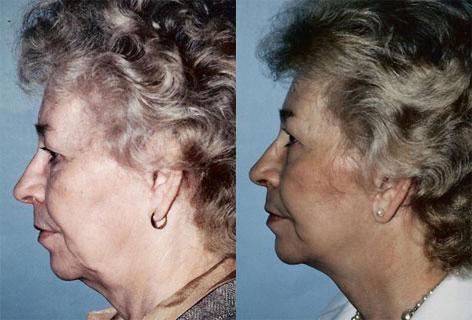 Facelift before and after photos in San Francisco, CA, Patient 14988