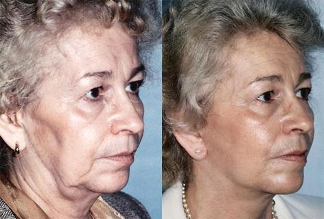 Facelift before and after photos in San Francisco, CA, Patient 14988