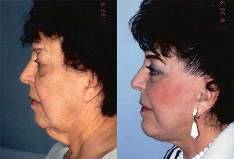 Facelift before and after photos in San Francisco, CA, Patient 14998