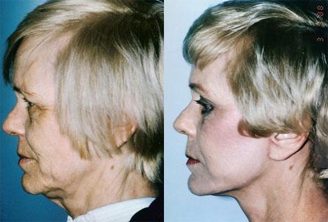 Facelift before and after photos in San Francisco, CA, Patient 15003