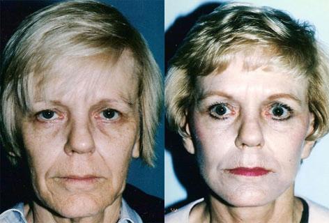 Facelift before and after photos in San Francisco, CA, Patient 15003