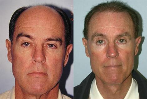 Facelift before and after photos in San Francisco, CA, Patient 15008