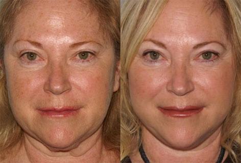 Facelift before and after photos in San Francisco, CA, Patient 15013