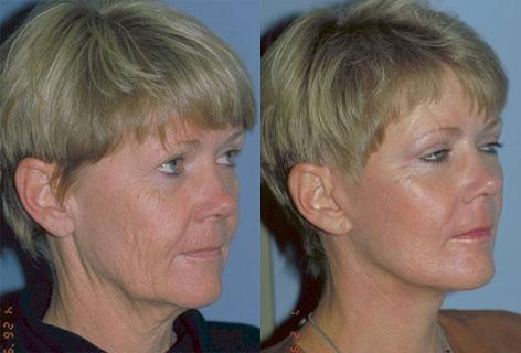 Facelift before and after photos in San Francisco, CA, Patient 15027