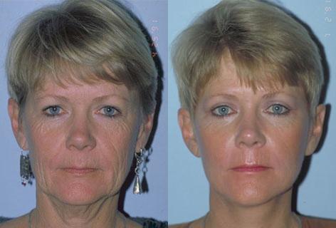 Facelift before and after photos in San Francisco, CA, Patient 15027