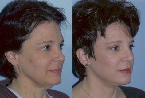 Facelift before and after photos in San Francisco, CA, Patient 15032