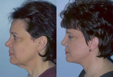 Facelift before and after photos in San Francisco, CA, Patient 15032