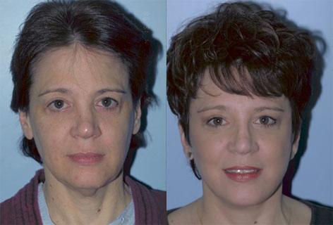 Facelift before and after photos in San Francisco, CA, Patient 15032