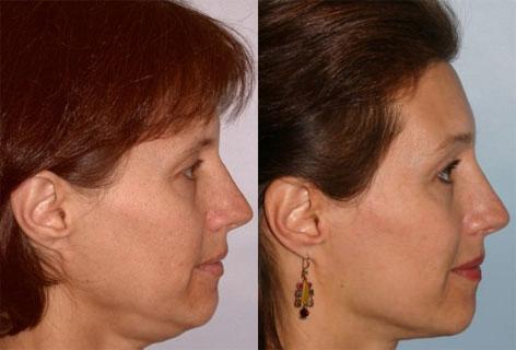 Facelift before and after photos in San Francisco, CA, Patient 15039