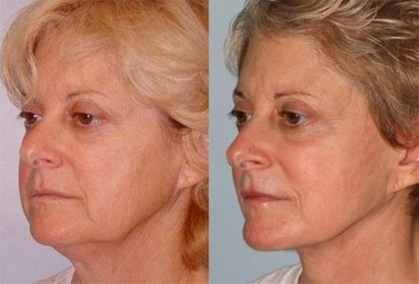 Facelift before and after photos in San Francisco, CA, Patient 15046