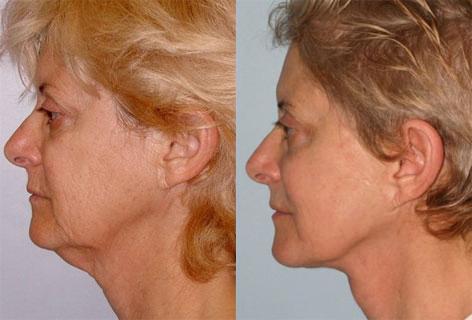 Facelift before and after photos in San Francisco, CA, Patient 15046