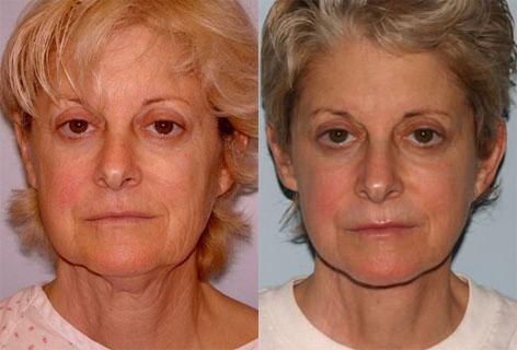 Facelift before and after photos in San Francisco, CA, Patient 15046