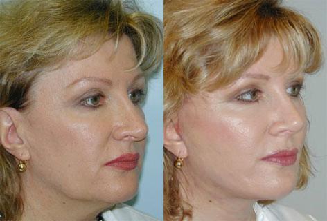 Facelift before and after photos in San Francisco, CA, Patient 15053