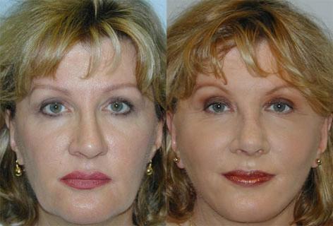 Facelift before and after photos in San Francisco, CA, Patient 15053