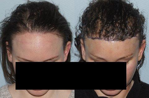 Hair Line Lowering before and after photos in San Francisco, CA, Patient 15093