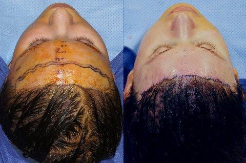 Hair Line Lowering before and after photos in San Francisco, CA, Patient 15093