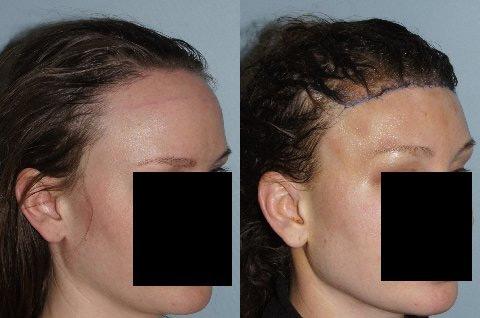 Hair Line Lowering before and after photos in San Francisco, CA, Patient 15093