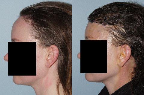 Hair Line Lowering before and after photos in San Francisco, CA, Patient 15093