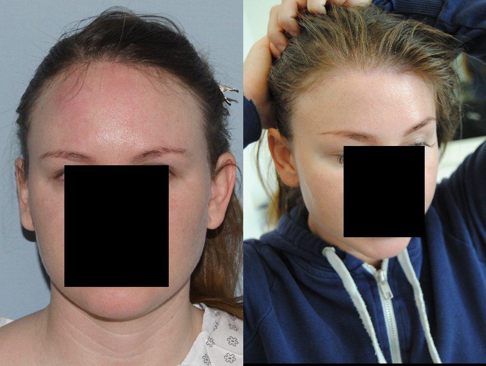 Hair Line Lowering before and after photos in San Francisco, CA, Patient 15093