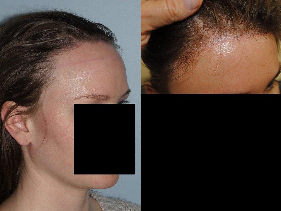 Hair Line Lowering before and after photos in San Francisco, CA, Patient 15093