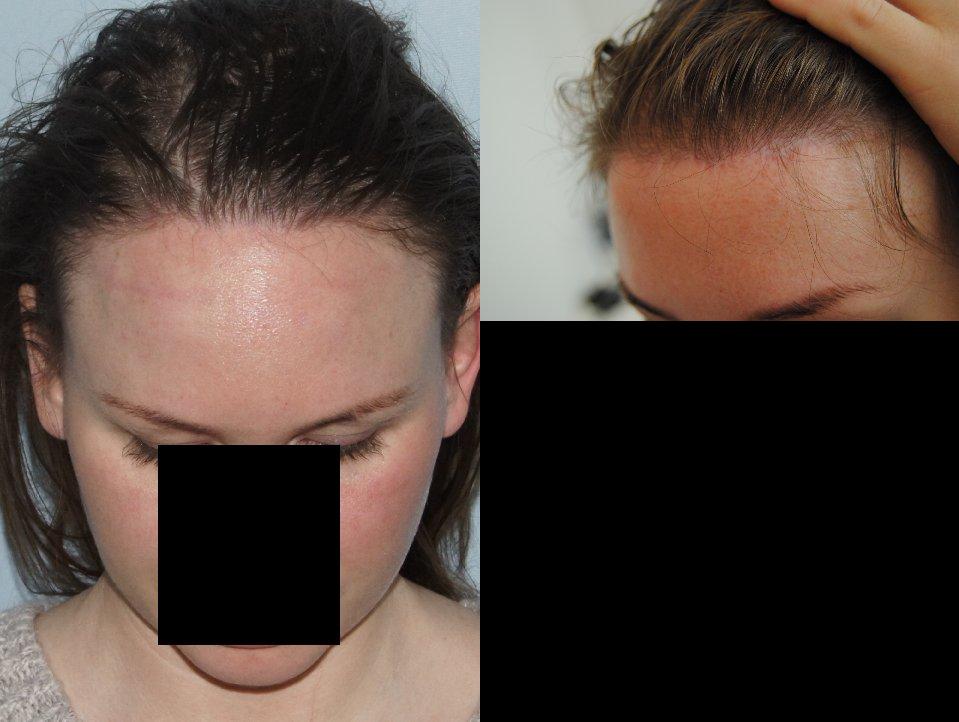 Hair Line Lowering before and after photos in San Francisco, CA, Patient 15093