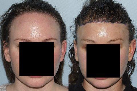 Hair Line Lowering before and after photos in San Francisco, CA, Patient 15093